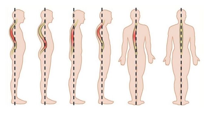 disturbi della postura come causa di osteocondrosi toracica