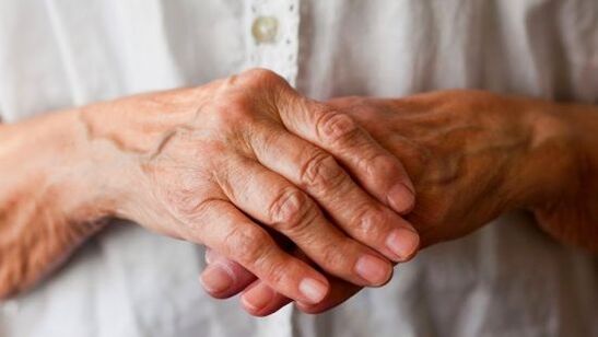 L’artrite reumatoide provoca dolore e gonfiore alle articolazioni delle dita. 