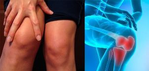 Il disagio e il gonfiore nella zona del ginocchio sono i primi sintomi dell'artrosi